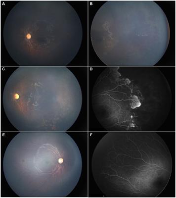 A retrospective study of ophthalmologic presentation, management, and outcomes in pediatric patients admitted with abusive head trauma